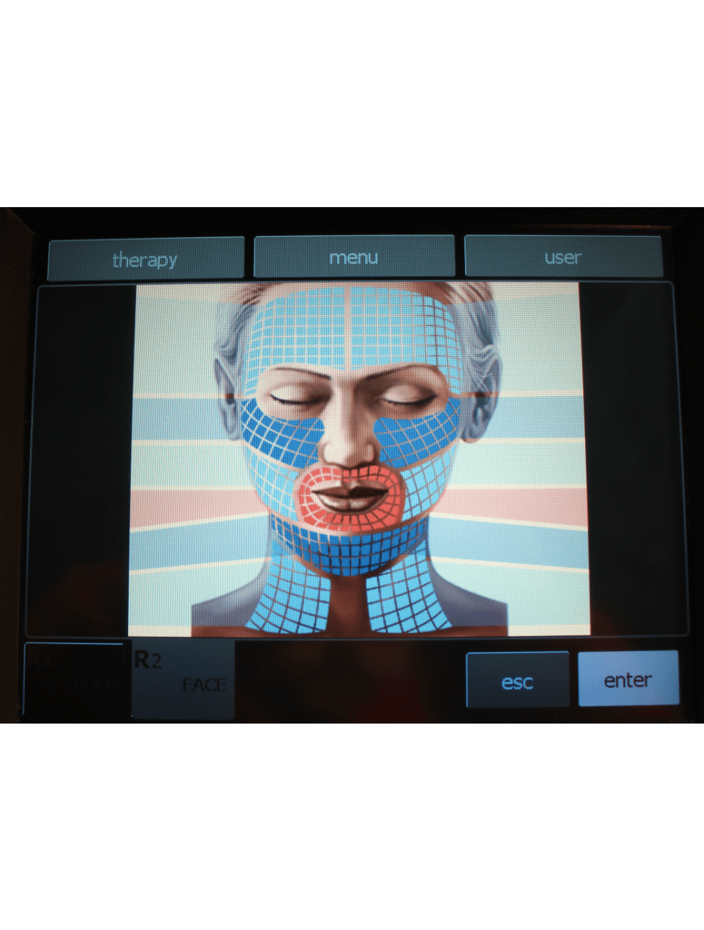 2011 BTL Exilis RF Wrinkle Tightening /w XP 2 & Large Handpieces