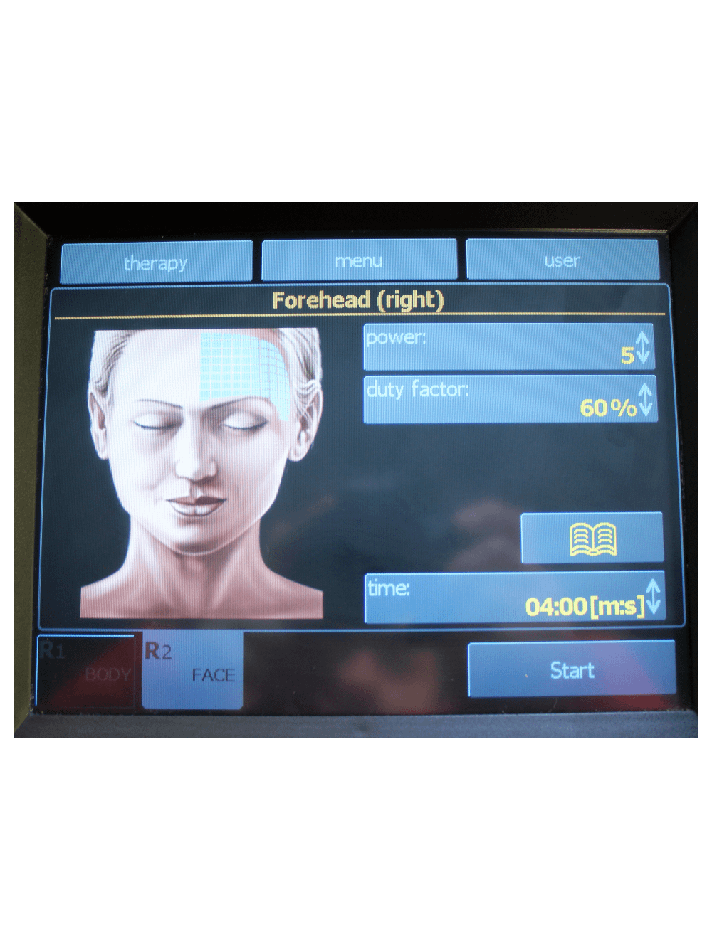 2011 BTL Exilis RF Wrinkle Tightening /w XP 2 & Large Handpieces