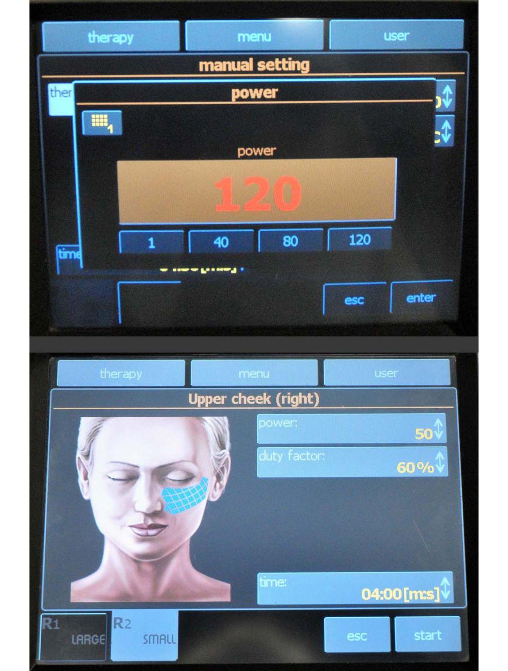 2011 BTL Exilis Elite Radio Frequency 120 Watt Laser Body Shape Skin Tightening