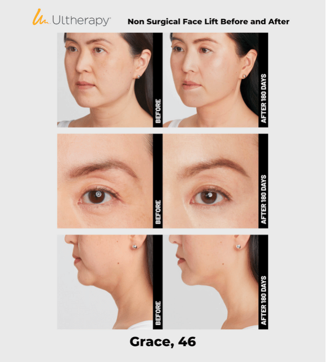 Ulthera Ultherapy DeepSee Transducer DS 10-1.5N (Orange Narrow) image 6