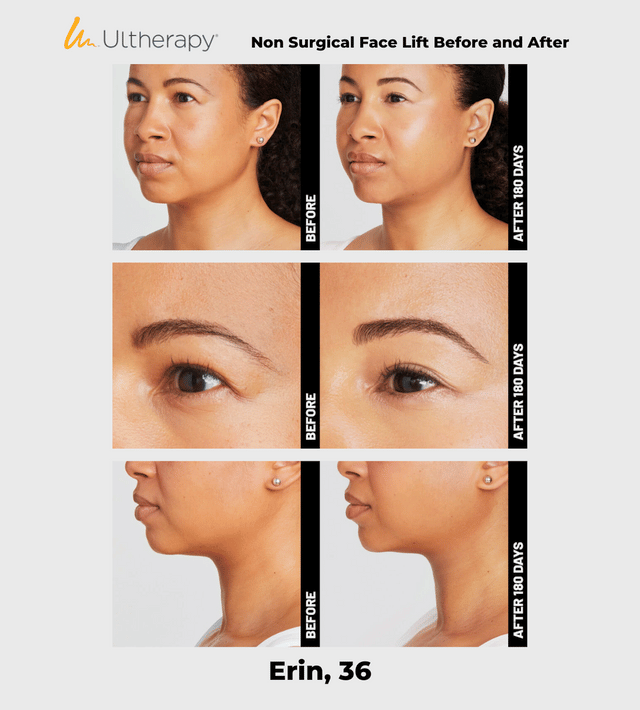 Ulthera Ultherapy DeepSee Transducer DS 10-1.5 (Orange) image 5