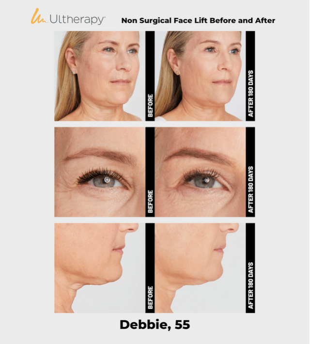 Ulthera Ultherapy DeepSee Transducer DS 7-3.0N (Green Narrow) image 7